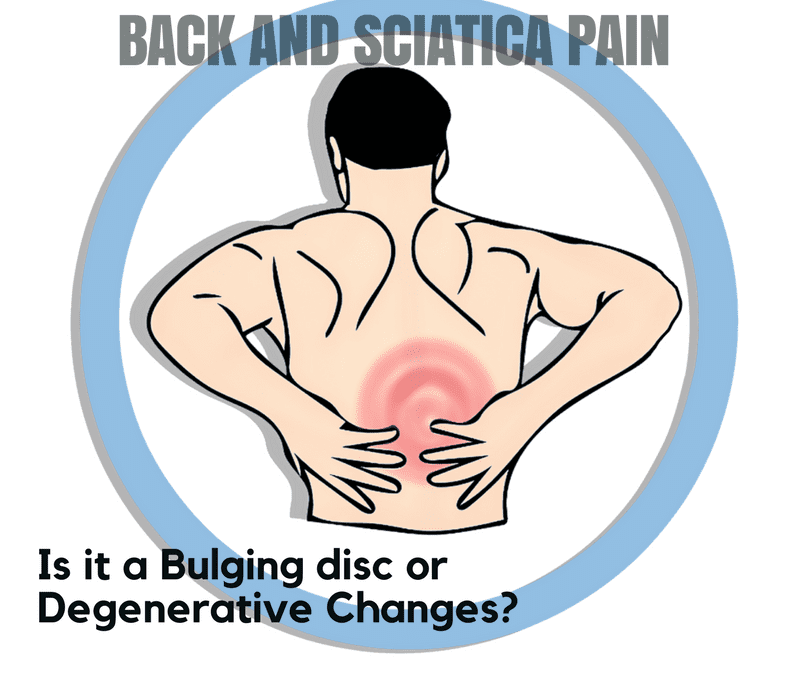 Back Pain & Sciatica: Is It a Bulging Disc or Degenerative Changes?